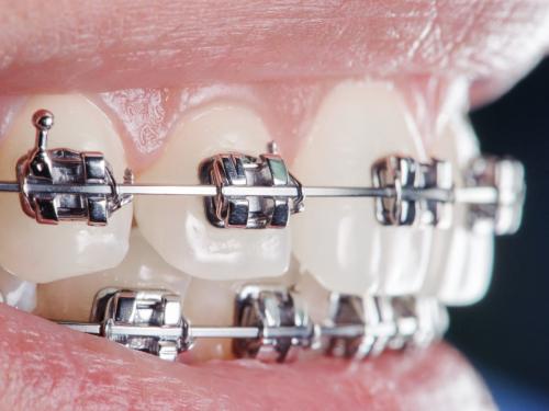 Braces And Orthodontics